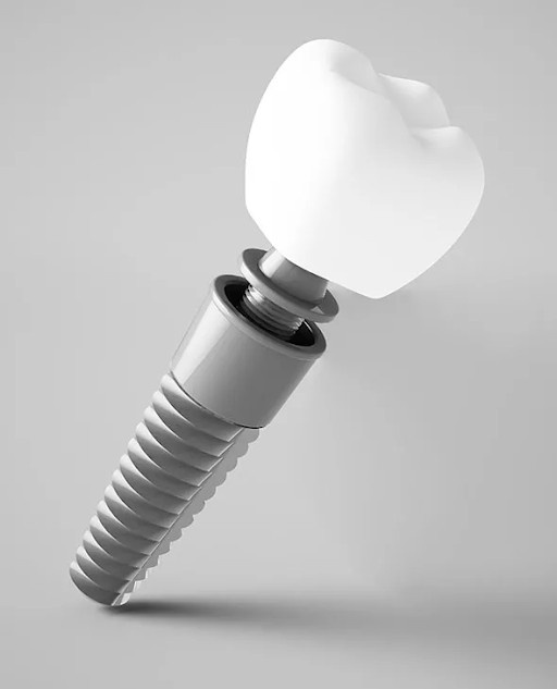 Can One Implant Replace More Than One Tooth?