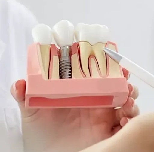 Thinking About Dental Implants? Read This First
